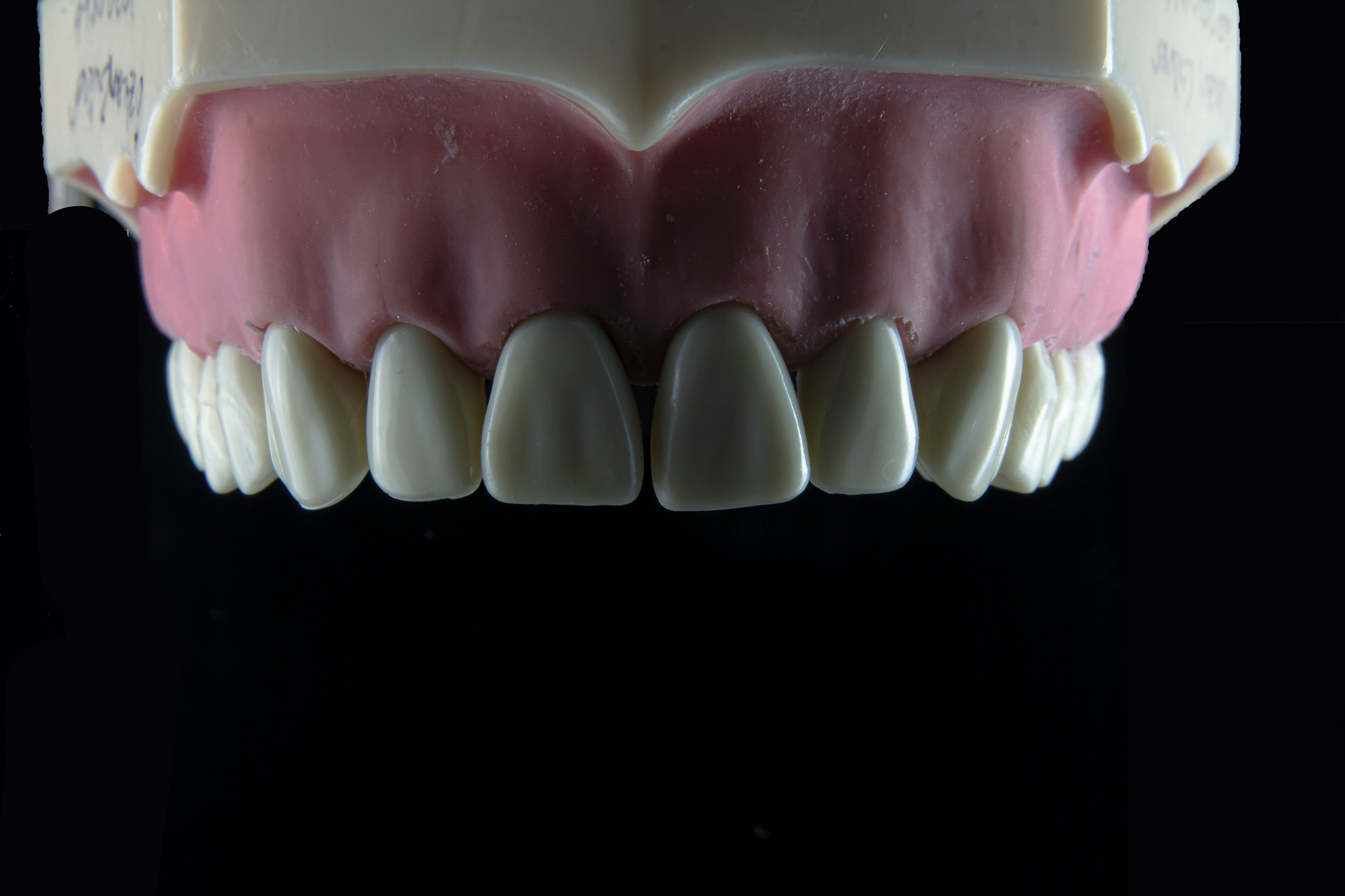 Dentures and bridge treatment result